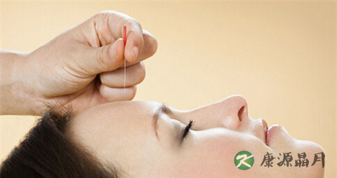 针灸治疗面瘫的方法
