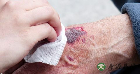 冬天手上冻疮痒怎么办 冬天手上冻疮痒怎么办