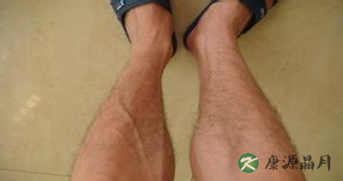 静脉曲张初期症状