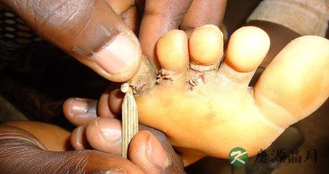 脚气泡要不要弄破