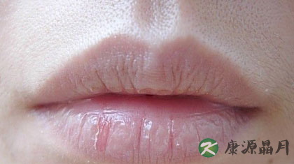 嘴唇起皮是什么原因