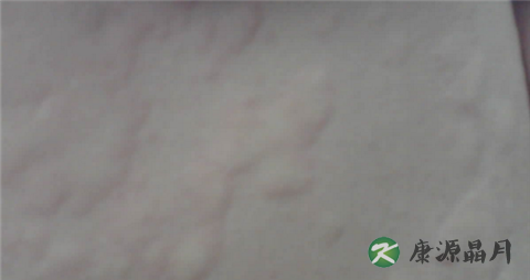 荨麻疹能治好吗