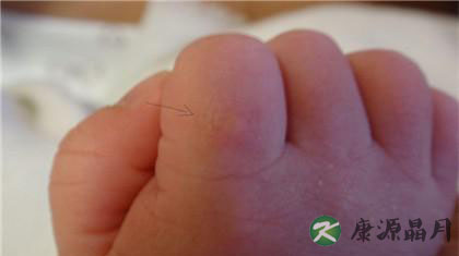 秋天如何预防手足口病