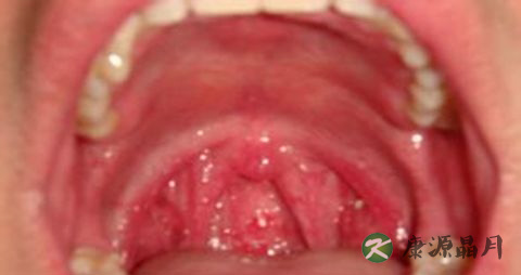 喉咙里总有痰怎么办