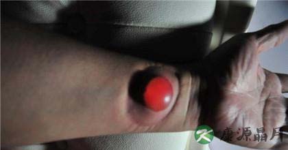 针刺拔罐发泡疗法案例剖析 针刺拔罐发泡疗法案例剖析