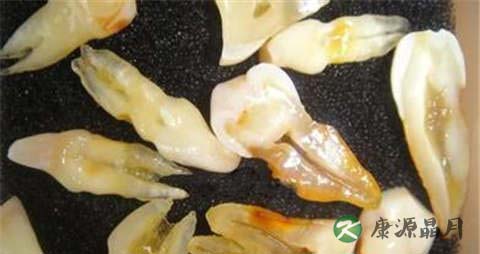 怎样去除牙结石