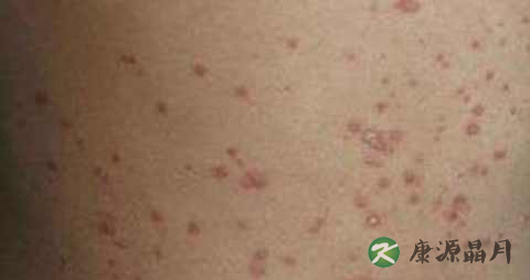 银屑病晚期是什么意思