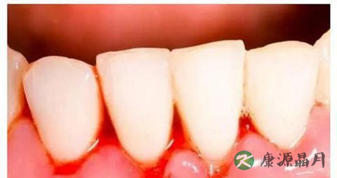 刷牙出血是怎么回事