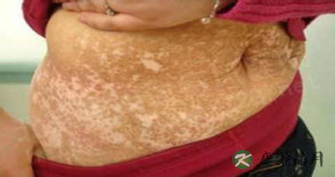 白癜风初期症状