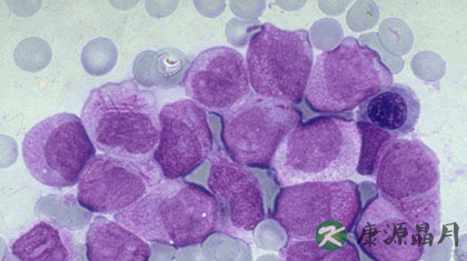 慢性粒细胞白血病是什么