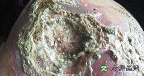 褥疮的治疗方法