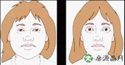 甲亢病症状的具体表现