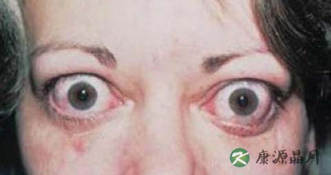 突眼症有什么危害