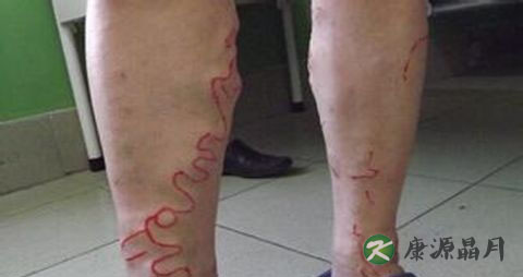 静脉曲张初期症状