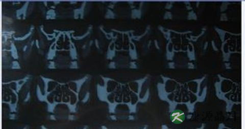 鼻窦炎的最好治疗方法