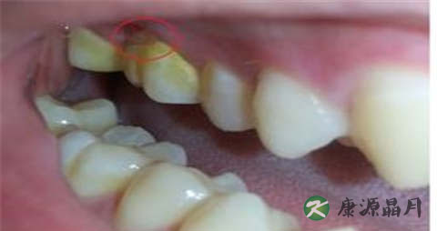 怎样去除牙结石