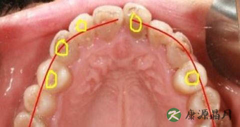 牙周炎吃什么药