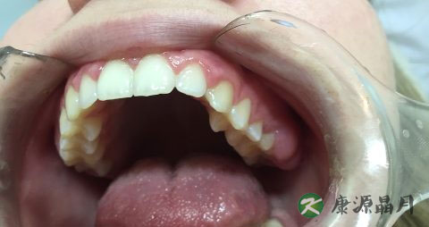 怎样预防龋齿 怎样预防龋齿