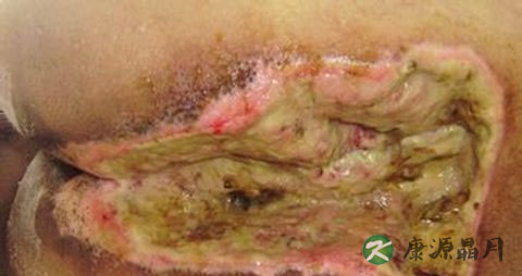 褥疮的治疗方法