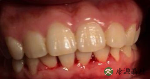 刷牙出血是怎么回事