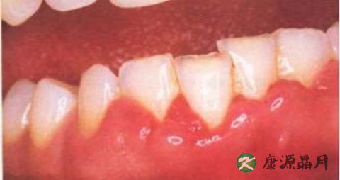 牙龈发炎怎么办