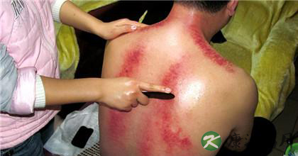 中医刮痧疗法采访实录