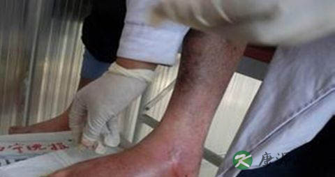 风湿病食疗与用药