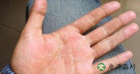 冬天手脱皮是什么原因 冬天手脱皮是什么原因