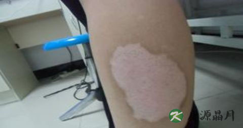 白癜风应该怎样治疗