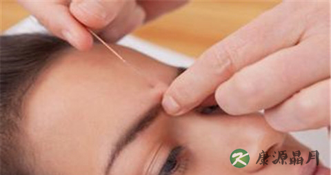 针灸治疗面瘫的方法