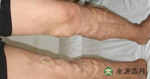 静脉曲张初期症状