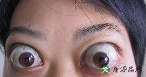 突眼症有什么危害