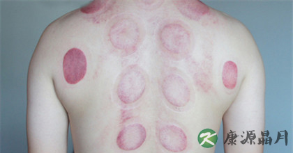 拔罐的好处与坏处