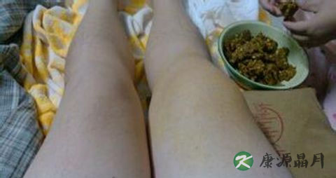 滑膜炎最佳治疗方法