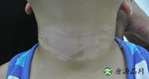 白癜风初期症状