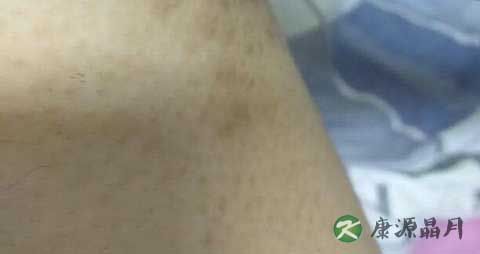 大腿肚内侧红点是什么