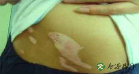 白癜风初期症状