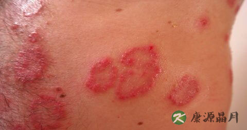 白癜风传染吗 白癜风传染吗