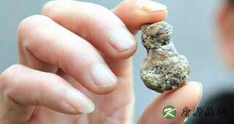 肾结石能吃西瓜吗