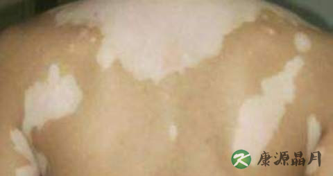 白癫和汗癣怎么区别