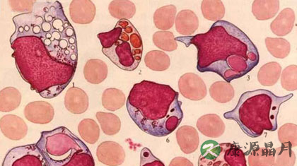 尿白细胞偏高是怎么回事