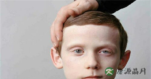 针灸治疗面瘫的方法