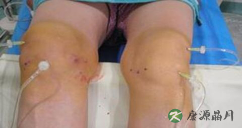 骨质增生的治疗方法有哪些