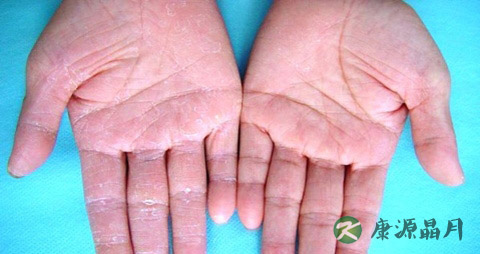 手癣最佳治疗方法