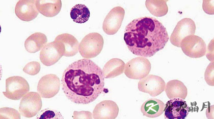 中性粒细胞百分比偏高的原因 中性粒细胞百分比偏高的原因