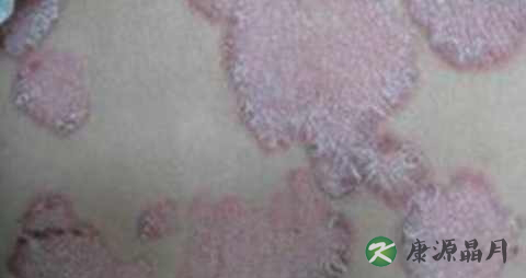 银屑病晚期是什么意思