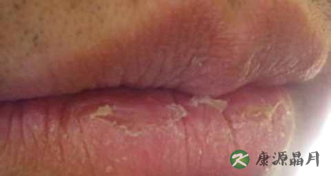剥脱性唇炎怎么治