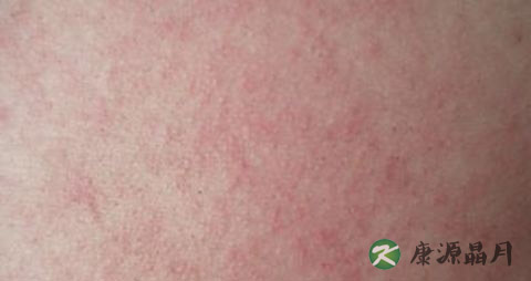 皮肤病治疗方法