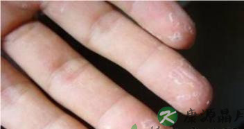 冬天手脱皮是什么原因 冬天手脱皮是什么原因