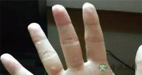 治疗手廯的药草